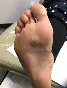 warts